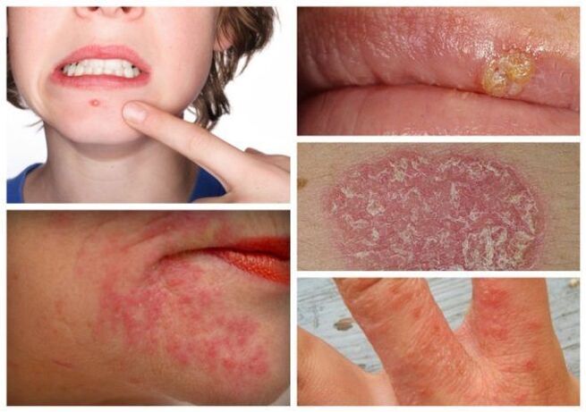 Οι αλλεργίες και οι δερματικές παθήσεις είναι σημάδια παρασίτων στο σώμα
