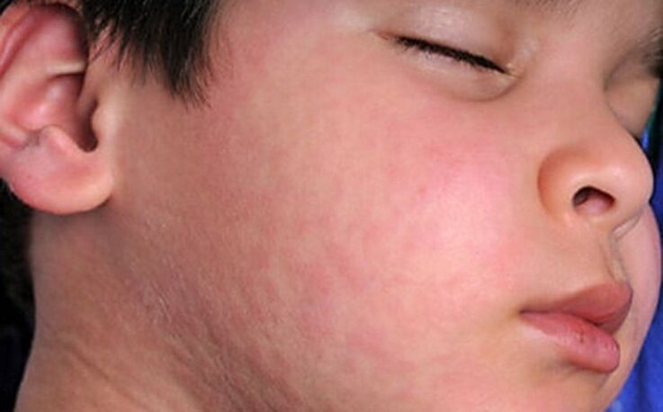 Αλλεργικά εξανθήματα στο δέρμα - ένα σύμπτωμα της παρουσίας παρασιτικών σκουληκιών στο σώμα